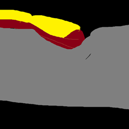 Augenkrebs (眼癌)